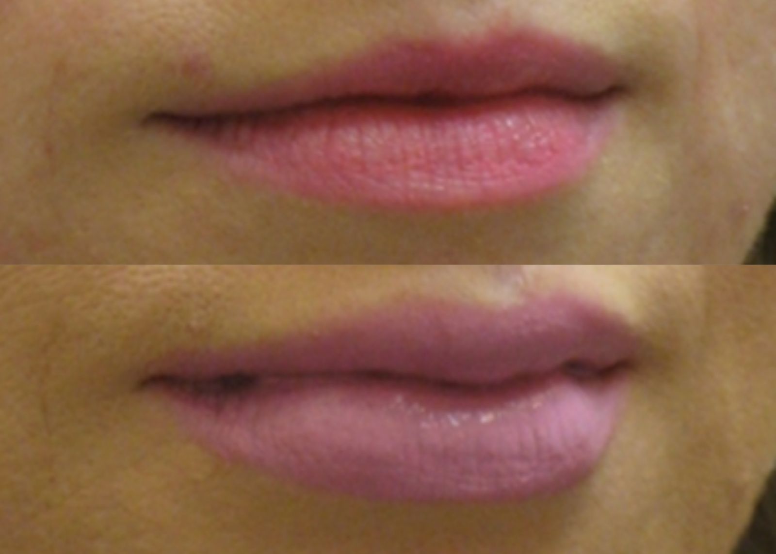 2 ml on thin lips