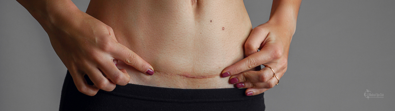 Scar Revision at Medical Spa Club
