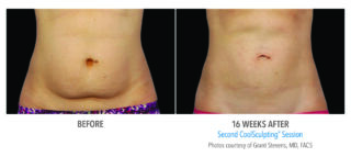 CoolSculpting in Richmond BC