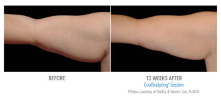 CoolSculpting in Richmond BC