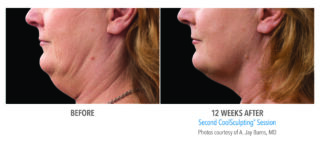 CoolSculpting in Richmond BC