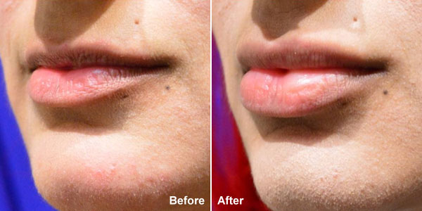 Lip filling treatment at the Medical Spa Club in Richmond BC.