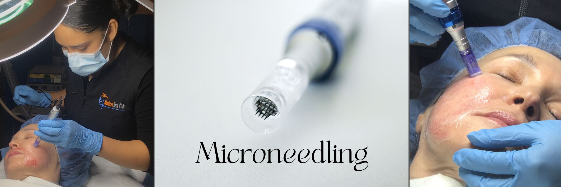Microneedling in Richmond BC