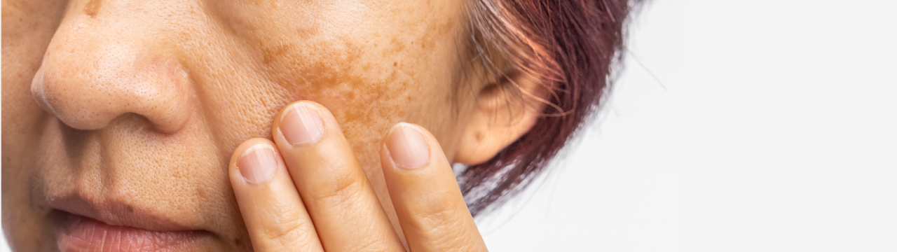 Close-up of facial pigmentation and dark spots on the cheek Close-up of facial pigmentation and dark spots on the cheek