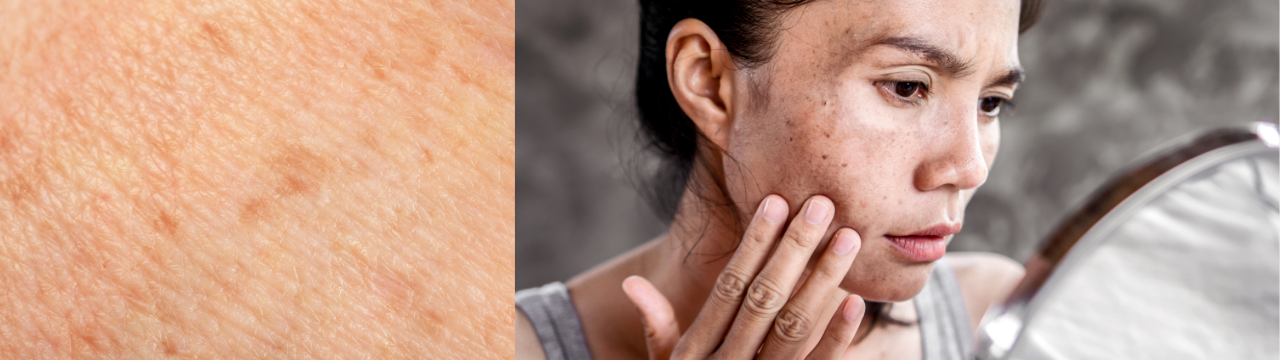 Woman showing facial hyperpigmentation and visible sun damage Woman showing facial hyperpigmentation and visible sun damage